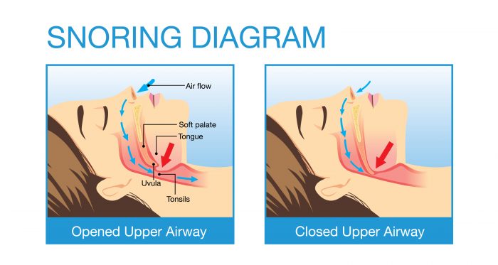 Obstructive Sleep Apnea (OSA) : Aspire Family Dental